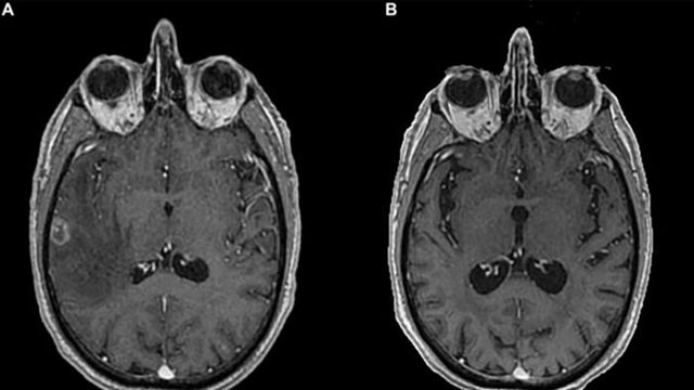 Brain MRI at diagnosis and last Brain MRI performed.