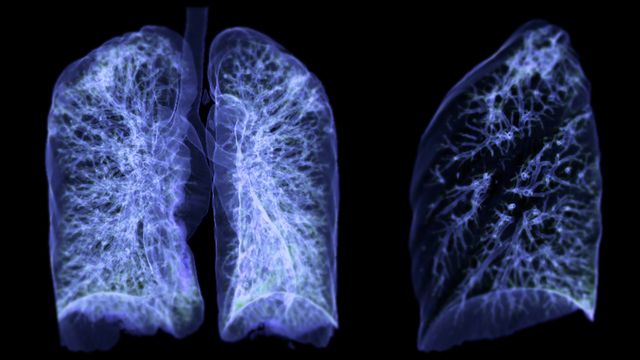 A scan image of a cancer infected set of lungs 